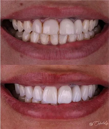 Antes e depois Odontaly