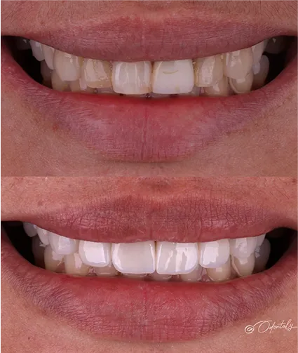Antes e depois Odontaly