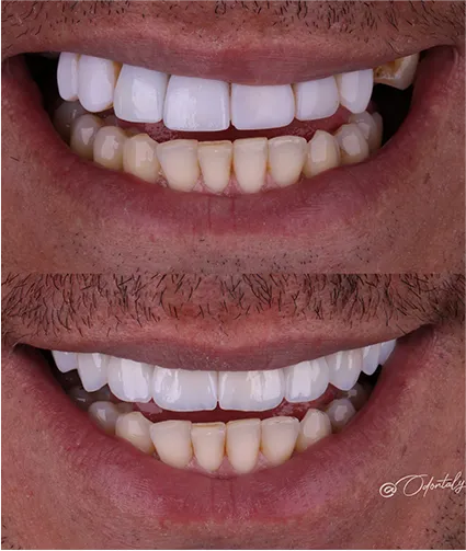 Antes e depois Odontaly