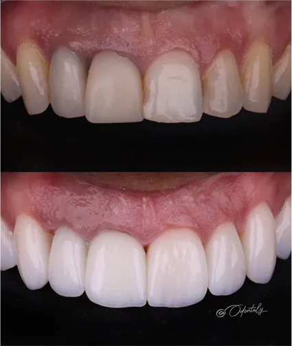 Antes e depois Odontaly