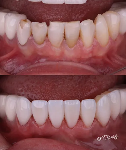 Antes e depois Odontaly
