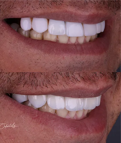 Antes e depois Odontaly