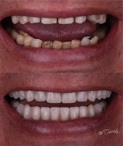 Antes e depois Odontaly