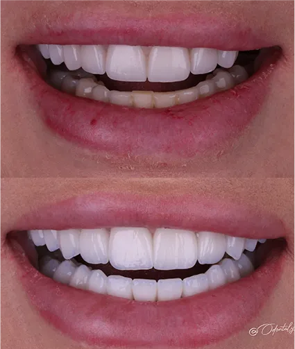 Antes e depois Odontaly