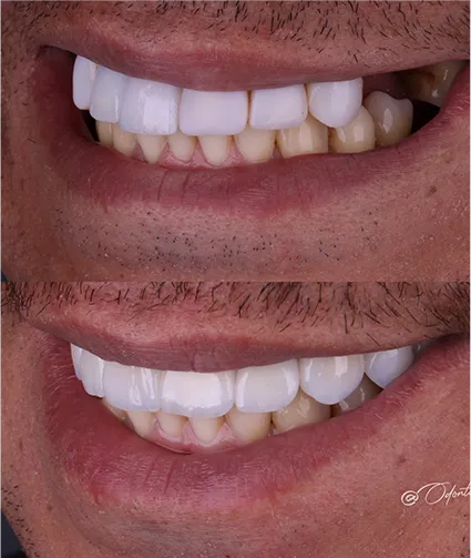 Antes e depois Odontaly